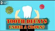What to do when a tooth decays under a crown? - Dr. Ranjani Rao