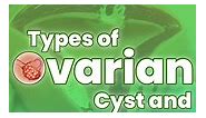 Types of ovarian cyst and what is looks like! Check this out ,..For more tips and guides ,please message me!#ovary #cyst ovariancyst #cancer #pcos #pcosawareness #pcos30#WomensHealth #coachbarbie #WomensHealth #pcoscoachbarbie #PCOSCHALLENGE #pcosweightloss #guide #symptoms ———————————————————— “For over 9 years of guiding women around the Globe to FIGHT PCOS, FIGHT OBESITY AND INFERTILITY .” We have the Right Tools for you in fixing your nutrition . AND ITS ALL FOR FREE! You are not alone . Wer