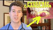 How to recognise and treat a Pyogenic Granuloma | Doctor O'Donovan