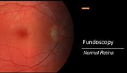 Healthy Retina: Fundoscopy
