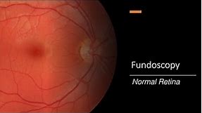 Healthy Retina: Fundoscopy