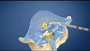 Intracept® Procedure for Chronic Low Back Pain | Cantor Spine Institute