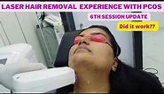Laser hair removal face before and after 6th session | Hair growth and Laser burn update