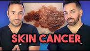Everything About Skin Cancer: Prevent, Identify, Biopsy, and Treatment | Dermatologist Explains