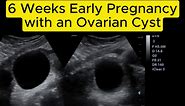 Ovarian Cyst - 6 Weeks Early Pregnancy #babykicks #babykicking #women #foryou #miracles #fyp #babies #pregnancy #pregnant #birth #babies #pregnancyweeks #pregnancyweekbyweek #wombmates #prenataldevelopment #Uterus