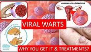 What are WARTS (HPV) ? - 3D Medical Animation