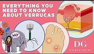 Everything you need to know about verrucas