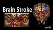 Brain Stroke, Types of, Causes, Pathology, Symptoms, Treatment and Prevention, Animation.