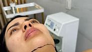 Lipomarcacion Submandibular con láser Logramos estilizar el rostro de nuestra paciente, alargando su cuello y dándole marcación a su mandíbula. Te esperamos 🫶 ✔️Resultados inmediatos y reales ✔️Sin dolor ✔️Bajo anestesia local ✔️Mas de 800 procedimientos exitosos ✔️Sin incapacidad 📍Bogotá, Colombia. . . . . . . Agenda tu cita via WhatsApp 📲📲3165427239 //3228021108 RECIBIMOS TODAS LAS TARJETAS #lipomarcagolden #lipo#lipopapada#colombia#bogota#lipomarcacion#goldenface#beutiful#l ipopapada | Go