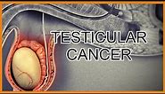 Testicular Cancer/Tumors