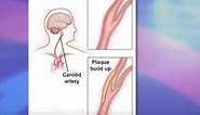 Risks and Benefits of Carotid Stenting