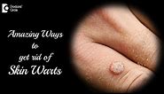 SKIN WARTS TREATMENT PROCEDURE. Stages of a wart falling off - Dr. Aruna Prasad | Doctors' Circle
