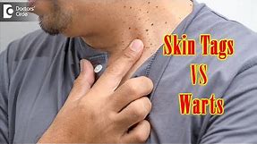 What Causes Skin Tags And Warts? | Get Rid of Warts & Skin Tags- Dr. Renuka Shetty | Doctors' Circle