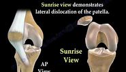 Patellar Dislocations - Everything You Need To Know - Dr. Nabil Ebraheim
