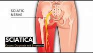 Sciatica, Causes, Signs and Symptoms, Diagnosis and Treatment