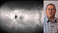 Peripheral Retinal Degenerations (2013) - Simon Browning B.Sc. (Hons) MCOptom