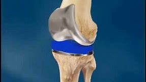 Total Knee Replacement Surgery (Arthroplasty) - University of Vermont Medical Center, Vermont