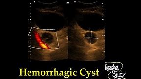 Adnexal Hemorrhagic Cyst || Ultrasound || Case 33
