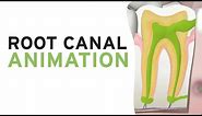 Root Canal Treatment RCT (Step by Step Animation)