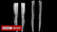Leg-lengthening: The people having surgery to be a bit taller - BBC News