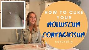Molluscum Contagiosum: How to cure it Naturally with Apple Cider Vinegar