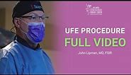 Uterine Fibroid Embolization (UFE) - Full Procedure Video - Atlanta Fibroid Center