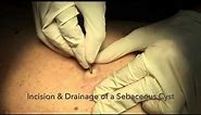 Incision & Drainage of a Sebaceous Cyst
