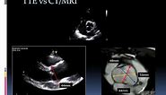 Echocardiographic assessment of bicuspid aortic valve
