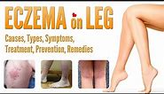 Eczema on Legs Causes, Pictures, Types, Symptoms, Treatment, Prevention, and Natural Home Remedies