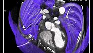 4D movie of heart using CT volume-rendering technique