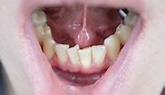 Invisalign Before and After Pictures - See Real Results