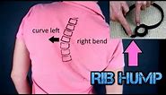 Rib Hump from Scoliosis - Why Do Your Ribs Stick Out?