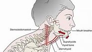 A common cause of TMD: Suprahyoid muscle clenching