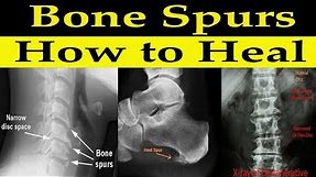 How to Heal Bone Spurs Naturally - Dr Alan Mandell, DC