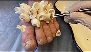 Parasites almost ate this foot - Saved a limb from trypophobia