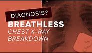 Chest X-Ray breakdown: a guide to lung adenocarcinoma