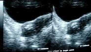 calcified fibroid on ultrasonography