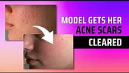 MODEL GETS HER ACNE SCARS CLEARED WITH COMBINATION TREATMENT | PATIENT STORY | Dr. Jason Emer