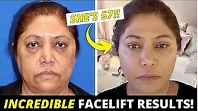 57 Year Old Looks 10 Years Younger With this INCREDIBLE Facelift Transformation!
