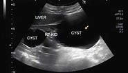 Ultrasound Video showing bilateral large simple renal cysts.