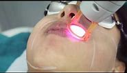 Laser hair removal for face