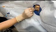 Small bore/Pigtail Catheter Chest Tube Insertion