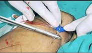 Femoral Line Catheterization Procedure | Central Line Placement | Central Venous Line Procedure|