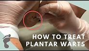 How To Treat Plantar Warts