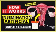 Artificial insemination in humans procedure - Intrauterine insemination (IUI): Fertility Treatment