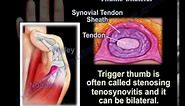 Thumb Pain , Trigger Thumb , Bilateral - Everything You Need To Know - Dr. Nabil Ebraheim