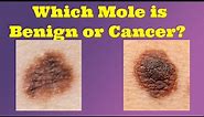 Could Your Mole be a Melanoma? How to Perform a Skin Cancer Check at Home