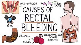 Understanding the Causes of Blood in Stool (Rectal Bleeding)