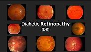 Diabetic Retinopathy (DR) - Pathophysiology, Stages, Screening, Prevention & Management of DR