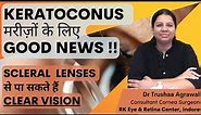 Scleral Contact Lenses : How to insert and remove ? Now get clear vision in Keratoconus.